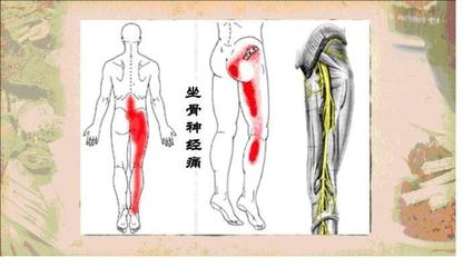 坐骨疼是怎么回事