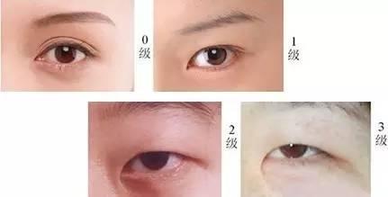 双眼皮为什么要开眼角