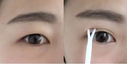 埋线好还是割好