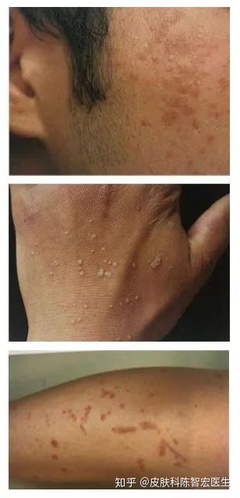 什么软膏对痘痘好