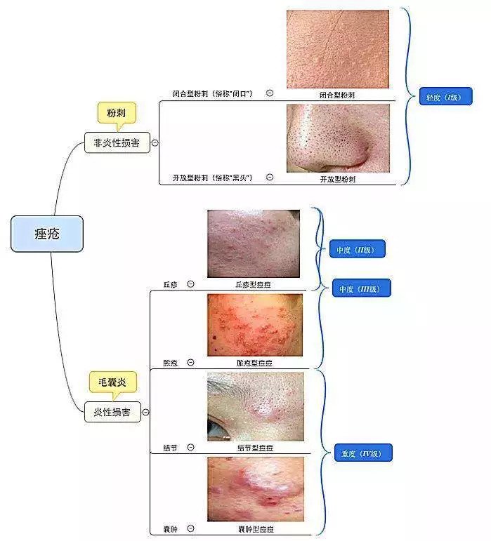 丘疹型痘痘严重么