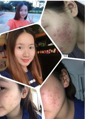痘痘方法的博客