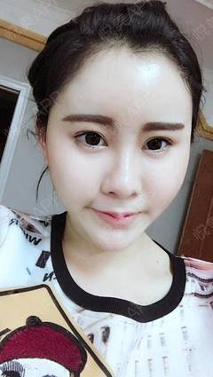 脸颧骨长痘痘