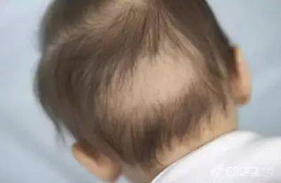 2岁多宝宝掉头发是什么原因