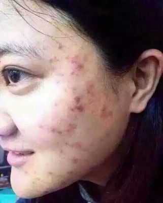 脸部起痤疮如何治