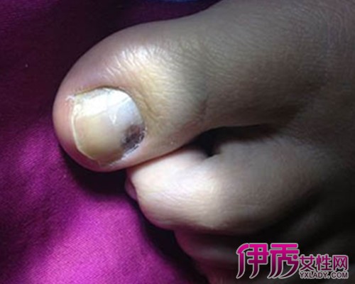 大脚指甲变黑是怎么回事