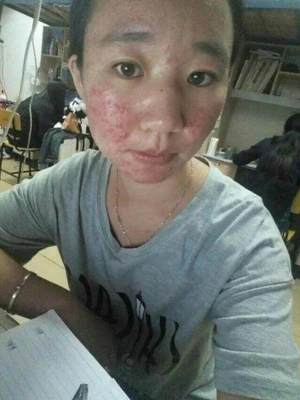 30岁痘痘一脸