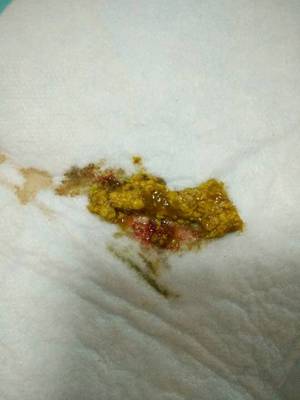 拉屎是红色的怎么回事