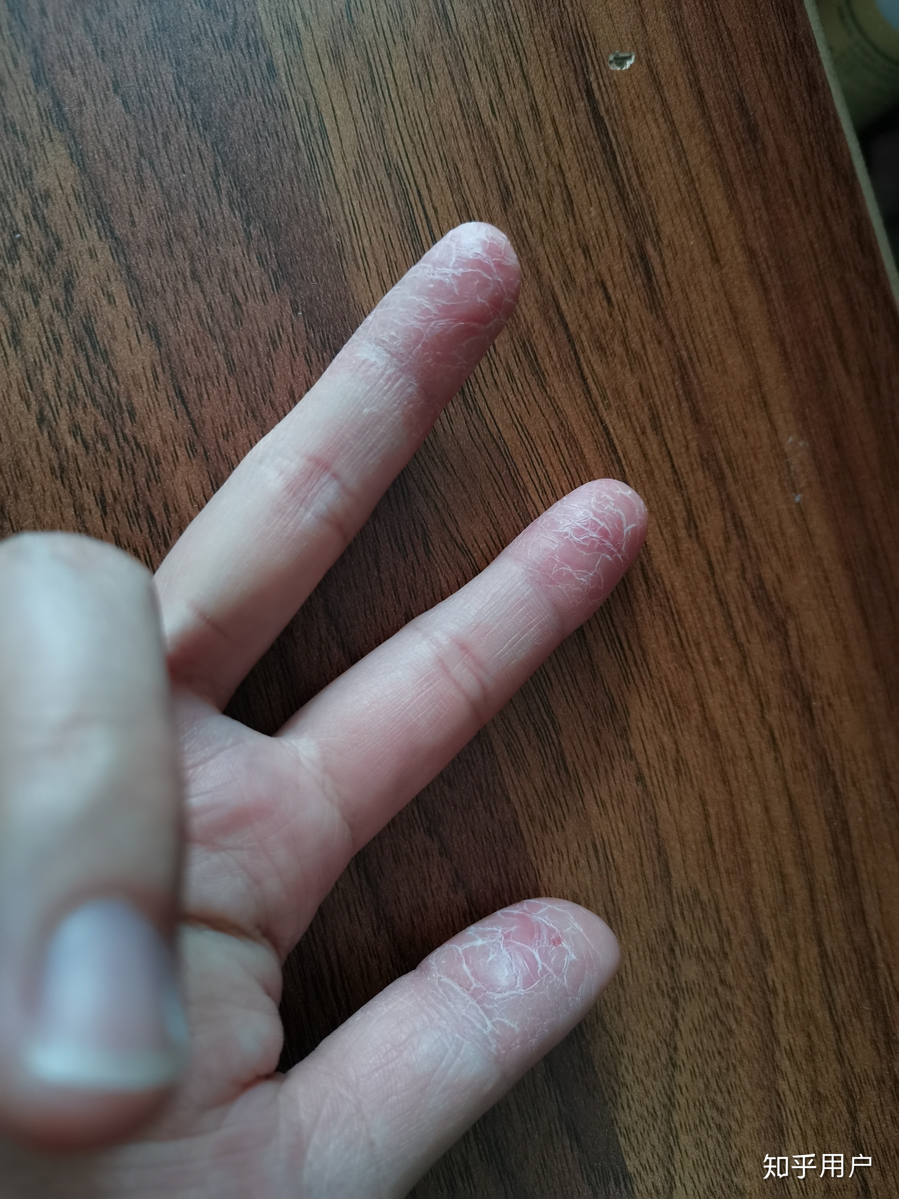 手指上起皮是怎么回事