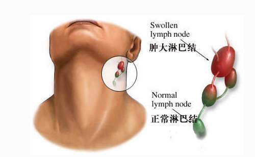 腋下淋巴肿大是怎么回事