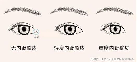 好看的内眦双眼皮