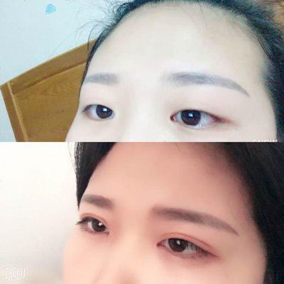 单眼皮肿眼泡怎么贴双眼皮