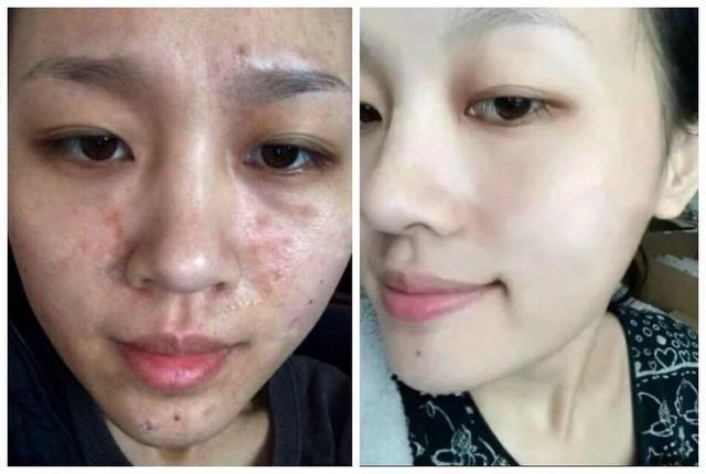 怎么改善痘痘脸
