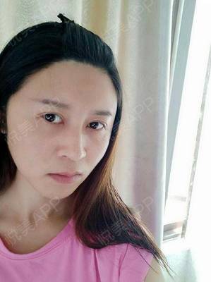 脂肪填充后下巴长痘痘