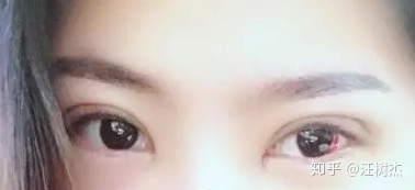做完双眼皮多久能带隐形眼镜