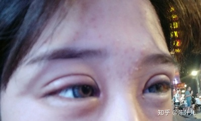 割双眼皮哭了怎么办