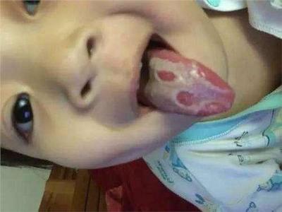 新生儿舌后坠