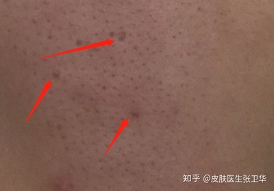 毛孔粗大痘坑