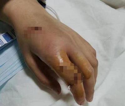 打架手指骨折赔偿标准