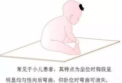 佝偻病怎么治疗效果好
