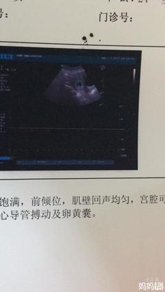 怀孕2个月最准看男女