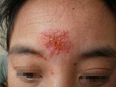 孢子丝菌皮肤病怎么治疗