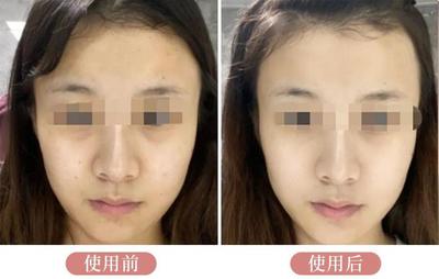 脸上有痘痘适合什么精华