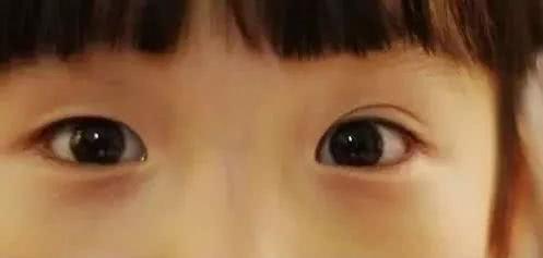 哭出双眼皮原理