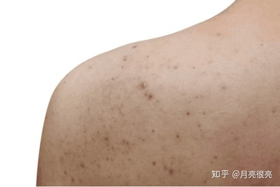 后背痘痘怎么去除