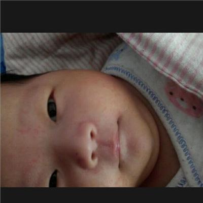 突然脸蛋长痘痘