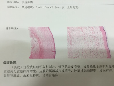 线状疣怎么治疗