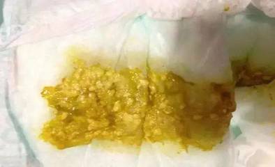 宝宝拉蛋花样大便