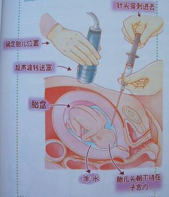 4个月胎儿羊水多少正常