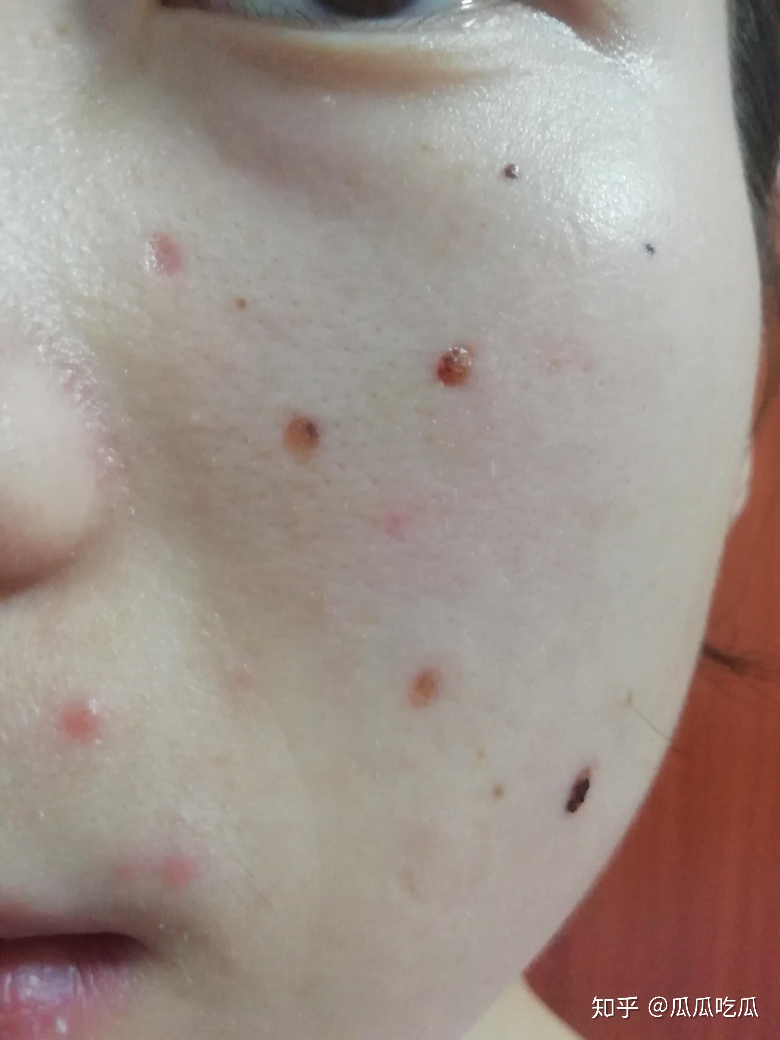多大的痣可以用激光点