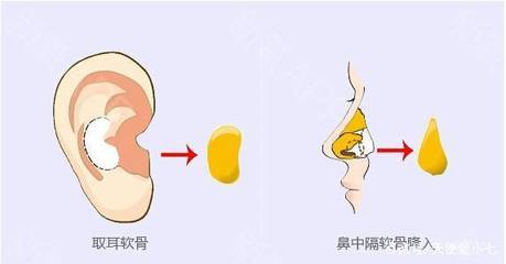 取耳软骨隆鼻疼吗