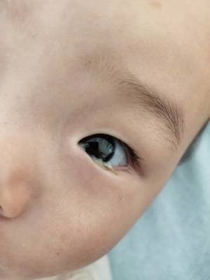 七个月宝宝眼屎多图片