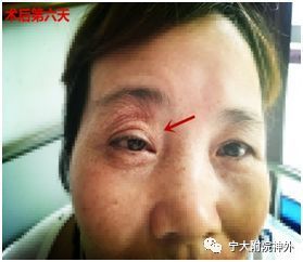 眼部肿胀