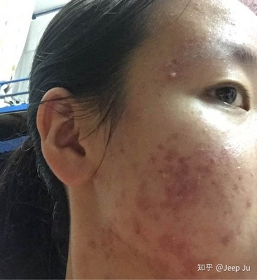 敏感肌肤痘痘发红