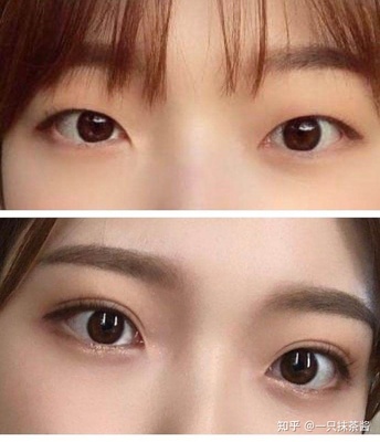 做双眼皮的形状