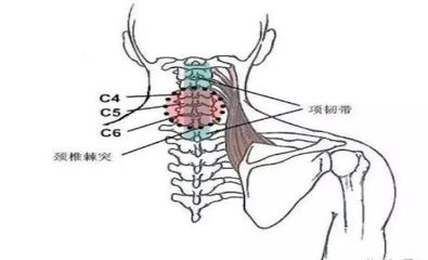后背颈椎疼是怎么回事