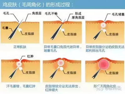 脸上毛孔一粒粒的凸起