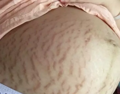 怀孕抹橄榄油有用吗