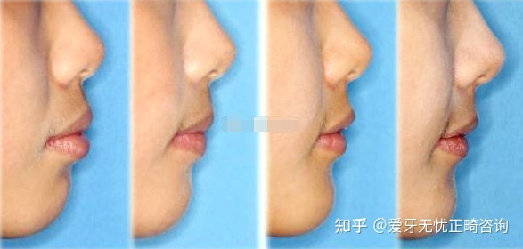 深覆合会怎样影响脸型