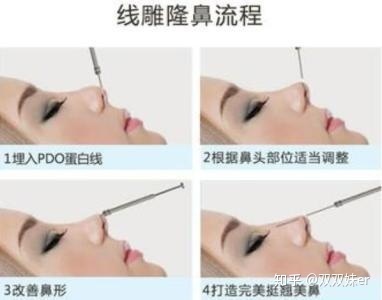 线雕隆鼻和玻尿酸区别