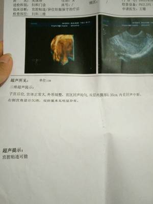 宫腔粘连怀孕怎么办
