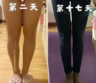 大象腿怎样快速的瘦腿