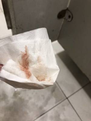 孕期分泌物正常是多少正常吗