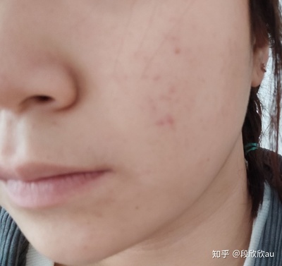 长痘痘打了几天消
