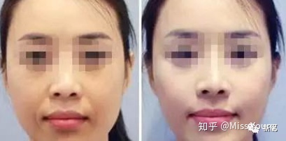 童颜针和水光针的区别