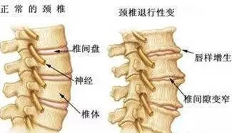 骨刺增生怎么治疗